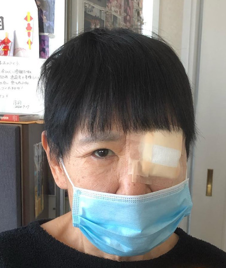 和田アキ子の黄斑変性症の注射手術後の姿